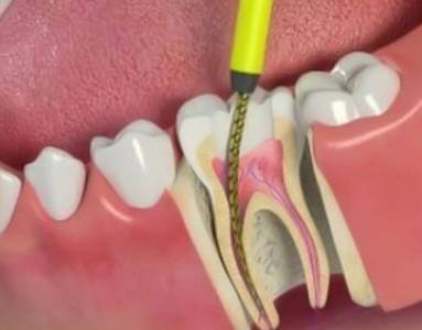 Root Canal