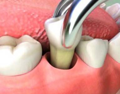 Tooth Extraction