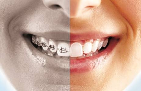 Teeth Braces In Indore