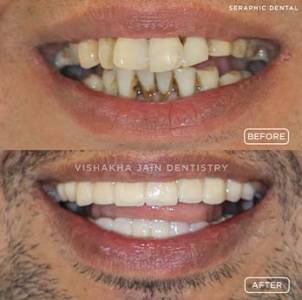 Advanced Implant Procedures