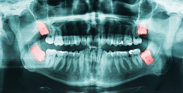 wisdom teeth removed in indore