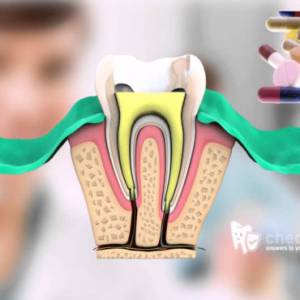 Root canal treatment