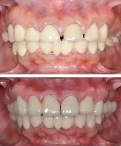 Full mouth Rehabilitation