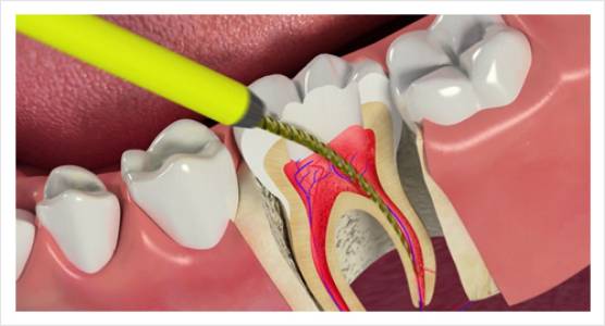 root canal