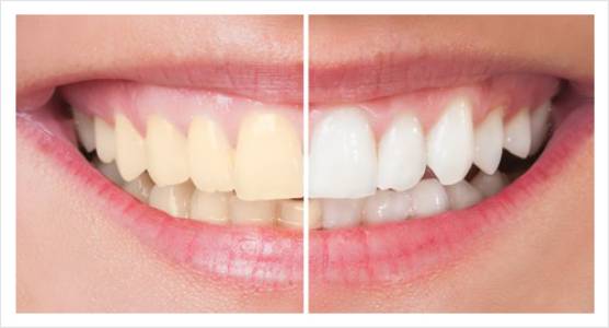 Teeth Whitening