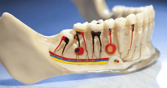 Root Canal Treatment