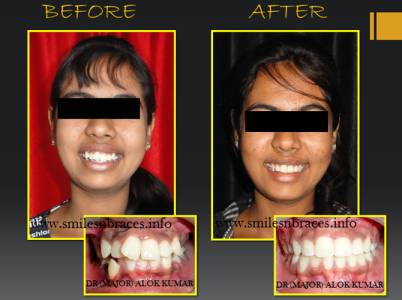 Crooked Teeth Treated By Fixed Orthodontics