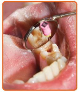 Root Canal Treatment