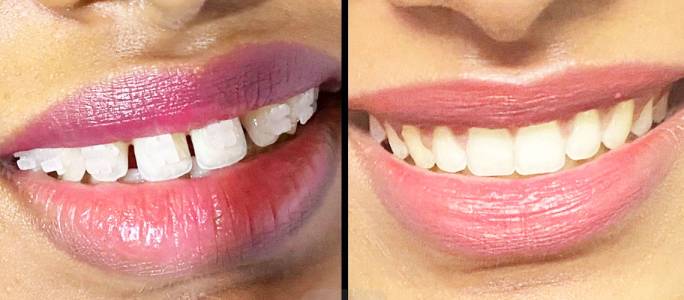 Root Canal Treatment