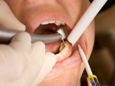 Root Canal Treatment (RCT)