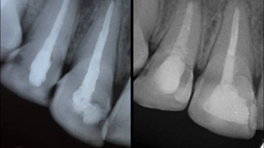 Root Canal Treatment in Bistupur