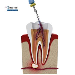 Painless Root Canal Treatment