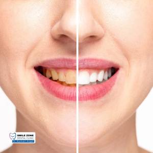 Teeth Whitening