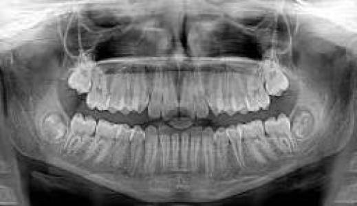 Dental X-Rays