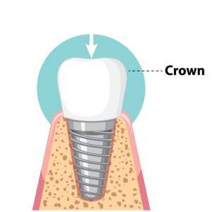 crown placement