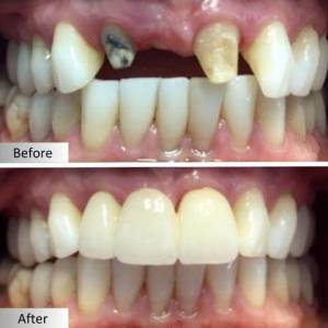 Full Mouth Rehabilitation