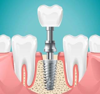 Dental implant