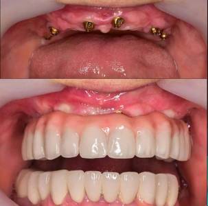 Dental Implant