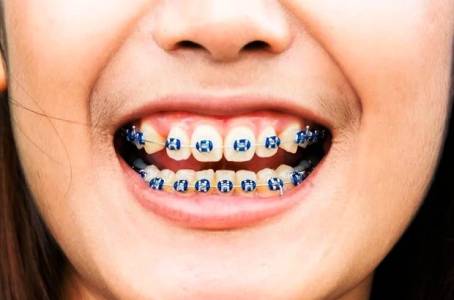 ORTHODONTIC TREATMENT