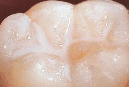 Pit and Fissure Sealant