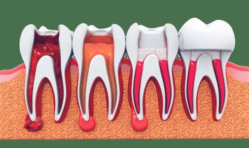 Root Canal Treatment