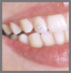 Fillings and sealants