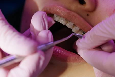 Orthodontic Treatment