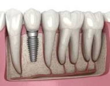 Implantology