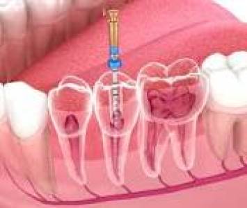 endodontic