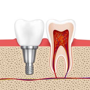 root canal