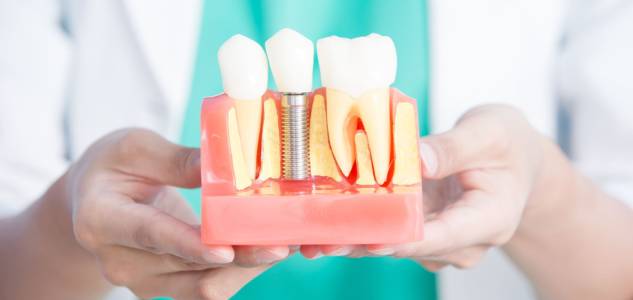 Dental Implants
