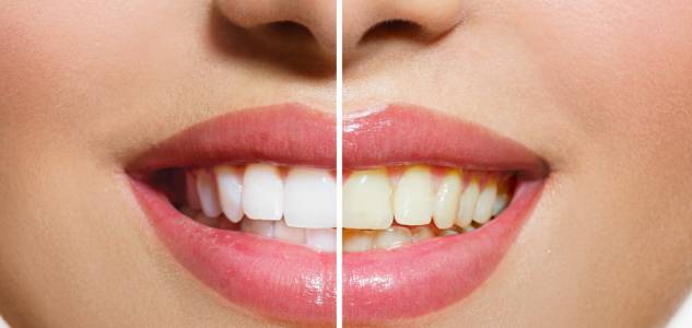 Teeth Whitening in Sambalpur