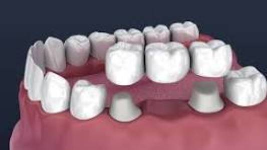 dental crown bridge