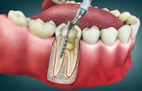 Root Canal Treatment (RCT)