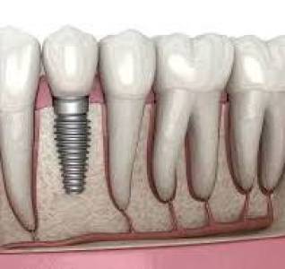 Dental implants