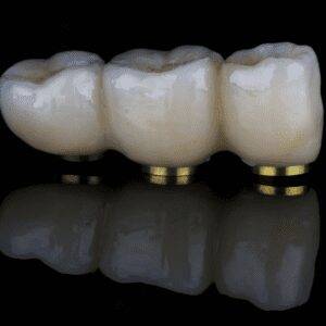 Prosthesis for fluent function