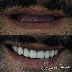 Full Mouth Rehabilitation