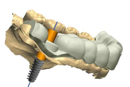 Computer Guided Implant Surgery