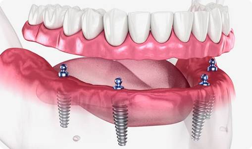 All-on-4, All-on-6 Dental Implant System