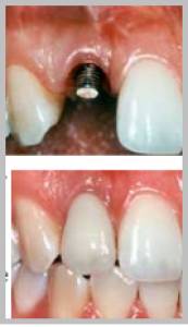 Pain Less Root Canal Treatment