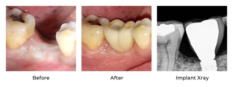 Dental Implants In Ahmedabad