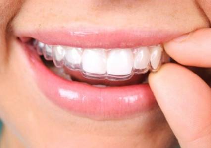 Aligners Treatment in Ahmedabad