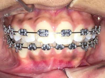Braces Treatment in Ahmedabad