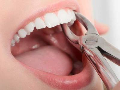 Tooth Extraction