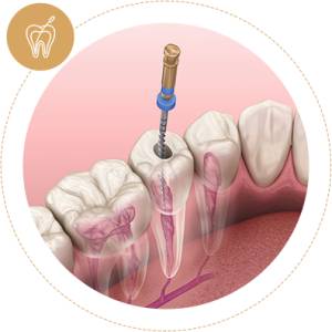 Root Canal Treatment