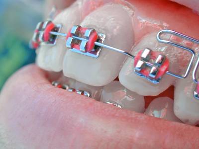 Orthodontic Treatment