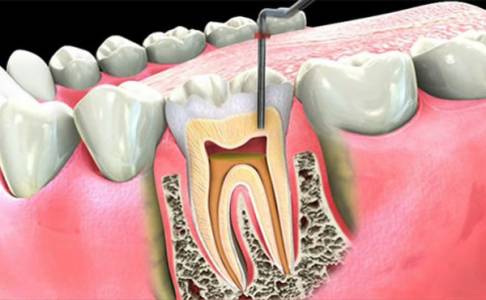 Root Canal