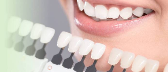 Dental Veneers