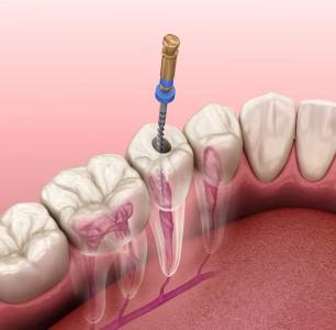 Root canal treatment