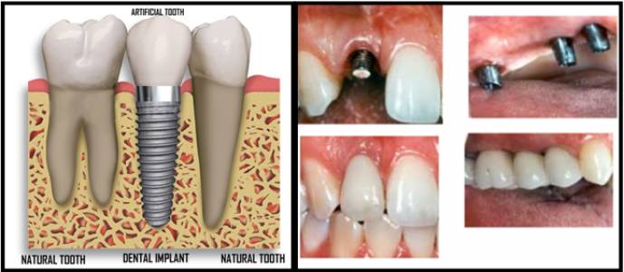 dental implants